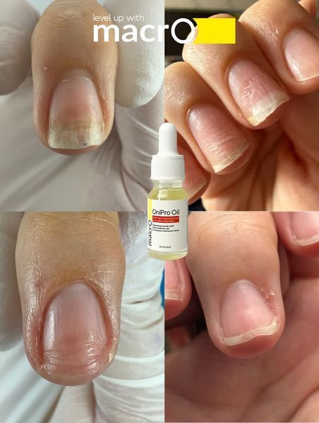 Олія від оніхолізісу macrO OniPro Oil, 10 мл ONIPRO-10 фото