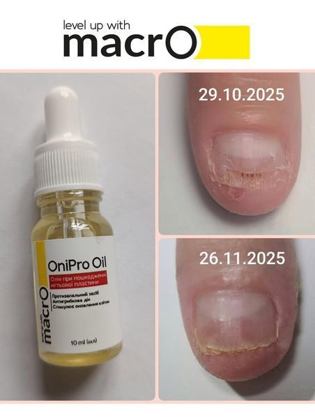 Олія від оніхолізісу macrO OniPro Oil, 5 мл ONIPRO-5 фото