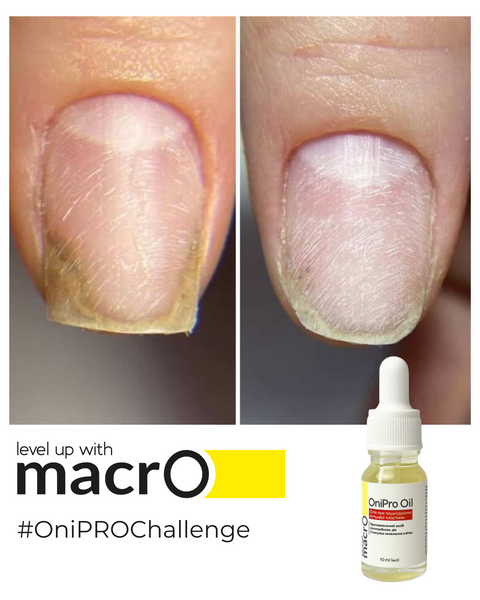 Набір олійок від оніхолізісу macrO OniPro Oil, 10 шт. ONIPRO-10-10 фото